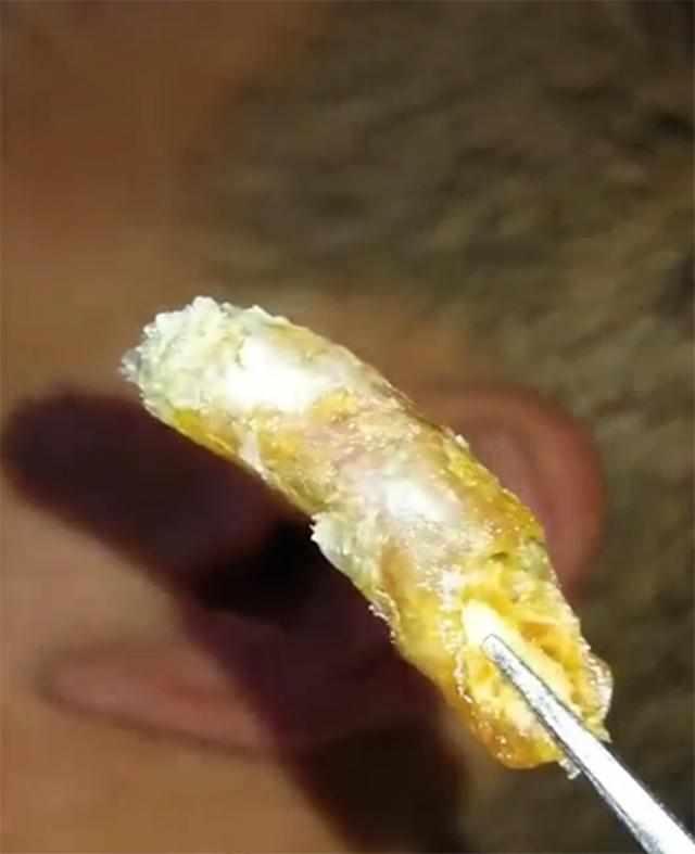 总觉得耳洞里涨, 男子请人掏耳朵, 从里面拽出一条“大黄虫”