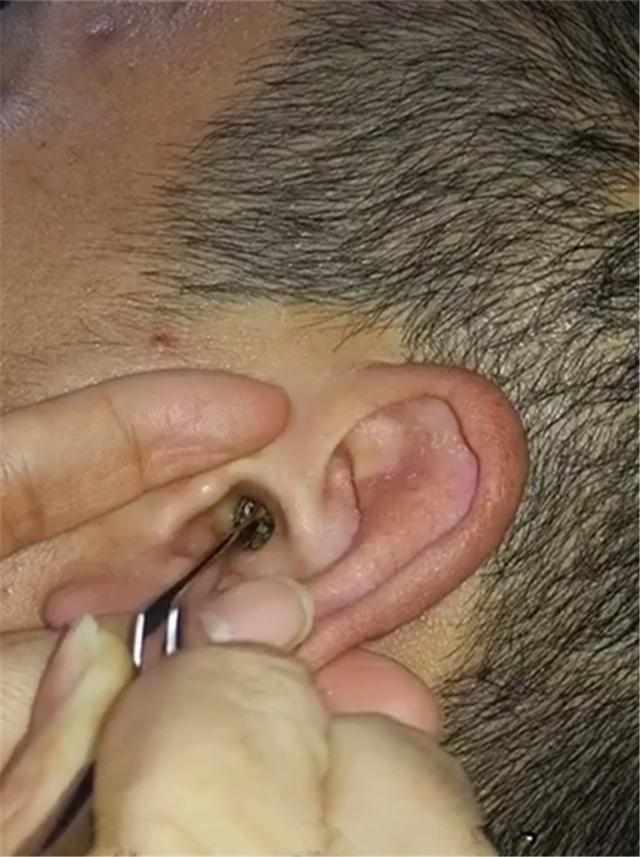 总觉得耳洞里涨, 男子请人掏耳朵, 从里面拽出一条“大黄虫”