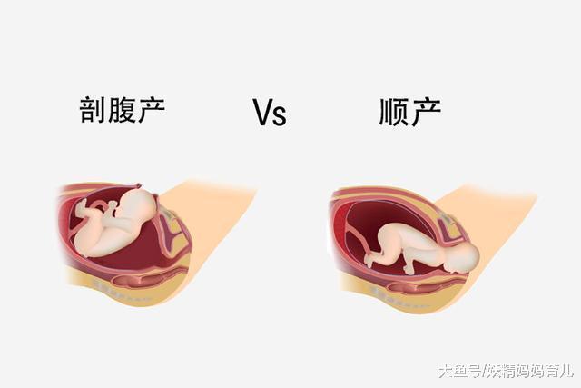 顺产、剖腹产优缺点大比拼, 选哪个好? 过来人这样说