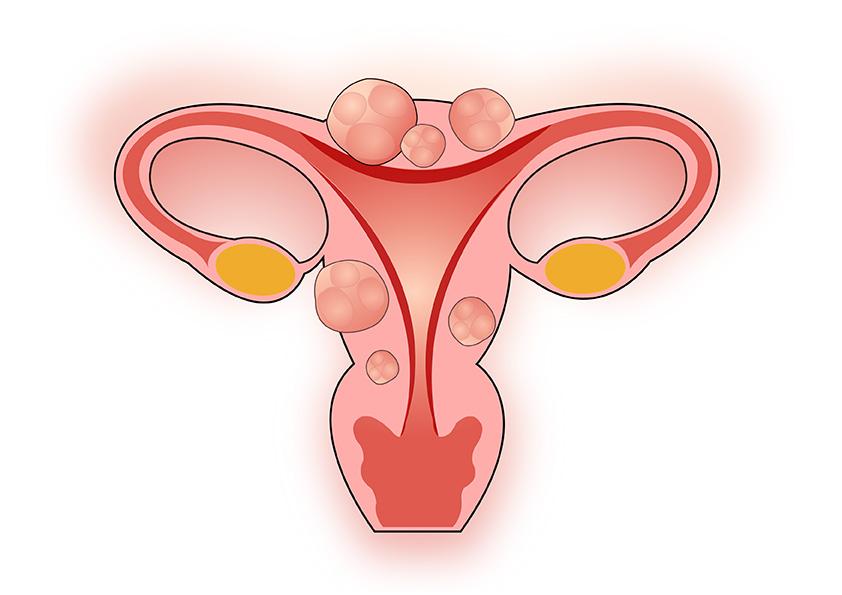 子宫肌瘤并没有你想象中那么可怕!