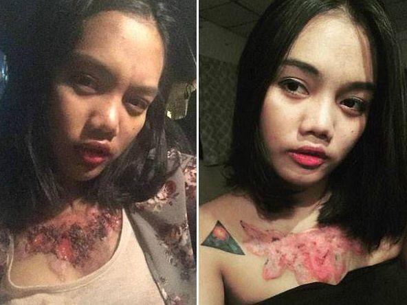 女子失恋去除纹身被人坑爹, 胸前留大片疤痕, 看了让人难受!