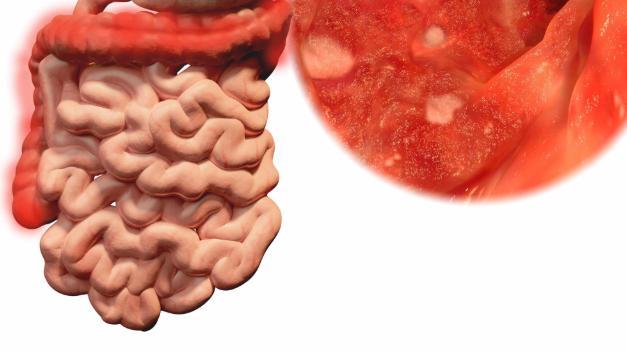 「直肠癌」饭后有这4个表现，当心是直肠癌来敲门的信号，别忽视