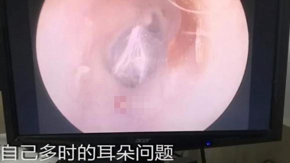 女子耳朵近日老是刺痛！里面的东西把医生吓了一跳，还是活的？