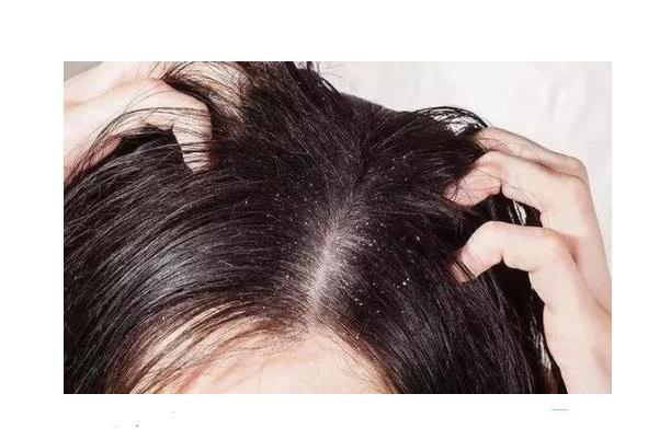 体检|头皮上总能抠出白色的泥？还有痘痘和小硬块？医生告诉你答案！