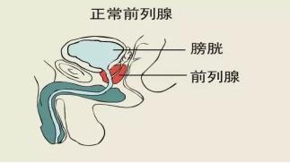 前列腺增生那点事儿