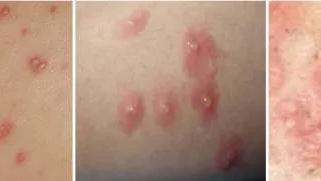 家属说|肿瘤患者出现皮疹怎么办？最强攻略在这里