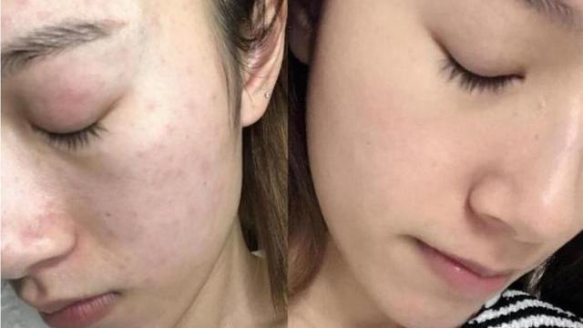 鹌鹑蛋 刚打湿脸洗面奶就直接涂？难怪那么多粉刺闭口，教你正确洗脸方法