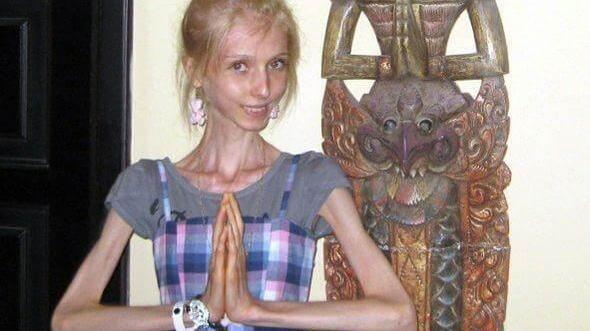 女孩|国外女孩患上罕见“厌食症”，看到中国美食后，病症却“不治而愈”！