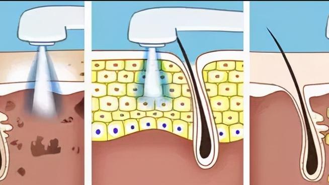 刷酸和光子联合的好，真的能有磨皮软件的效果