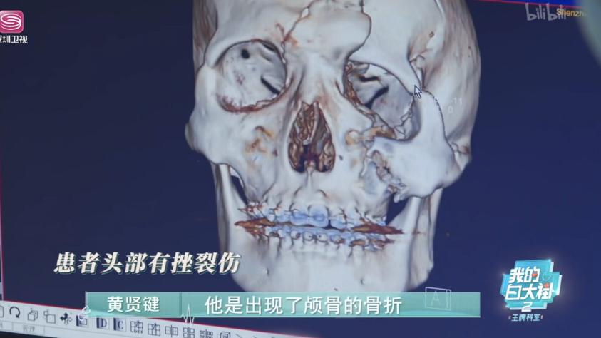 深圳一男子东西冲穿越，摔下悬崖致颅骨破裂