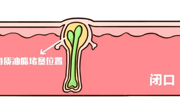 黄芪 建议有“闭口”的女生，坚持做好这几件事，高效解决不反复！