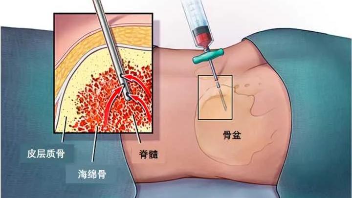 家属说|癌症最怕的就是转移？这中间暗藏的因素在这！