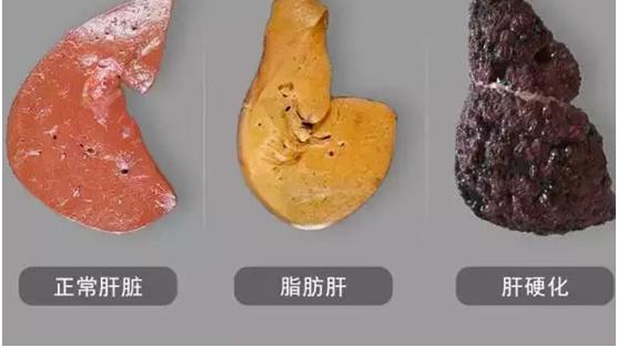 古今医案研读|肝上有癌，皮肤先知，皮肤若有3种“异常”，八成是肝病“信号”