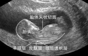 重庆北大阳光医院 关于NT检查，孕妈们想知道的都在这儿了~