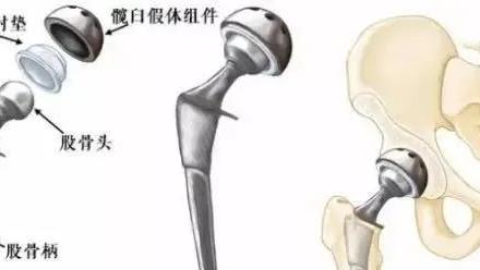 我叫小王|股骨头坏死置换不能一劳永逸
