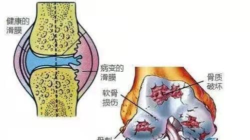 点评新生活|十个膝盖疼，九个有滑膜炎，巧用仙人掌，膝盖疼逃走