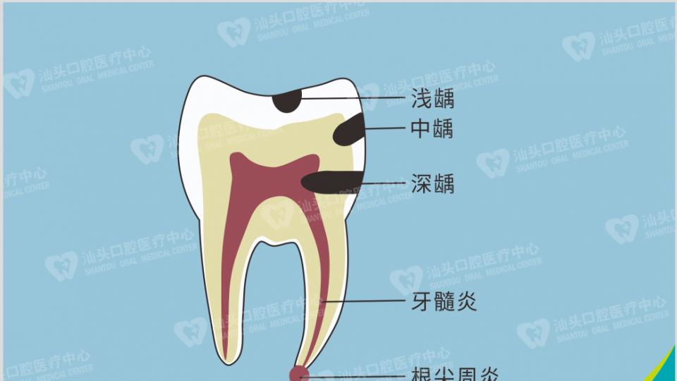 汕头口腔中心 为什么死髓牙会变颜色？有什么危害吗？看看如何处理