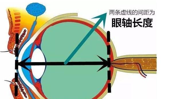 视界沐光VR视力|眼轴长度评估在近视防控中的重要作用!