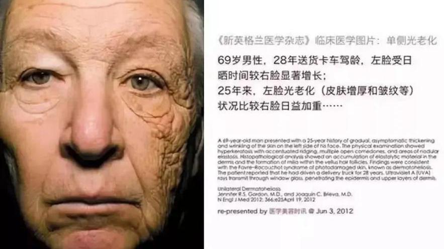 防晒 为什么要防晒？——养儿不防老，防晒才防老
