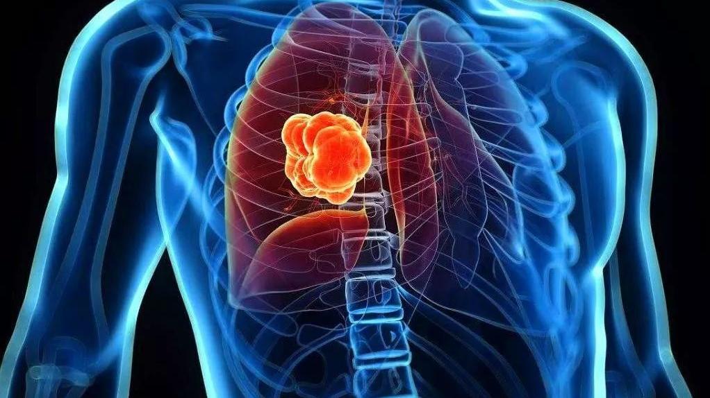 高圆圆 脑梗死预防大于治疗！医生坦言注意几点就可轻松预防