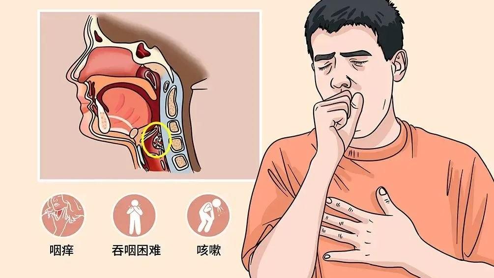 耳鼻喉申医生|秋季高发！如果你有咽干、咽痒、吞咽异物感，十有八九已中招！