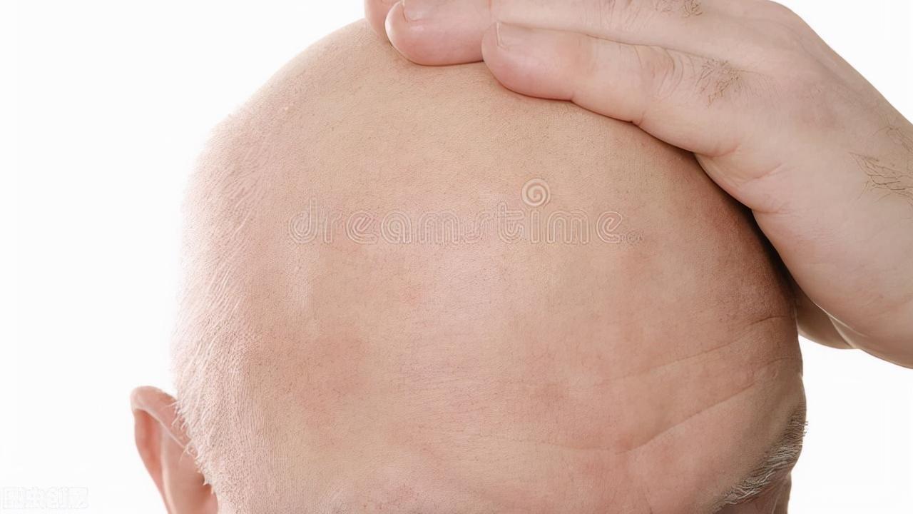 萝卜 快过年了，今年你是还顶着“秃顶”回家吗？