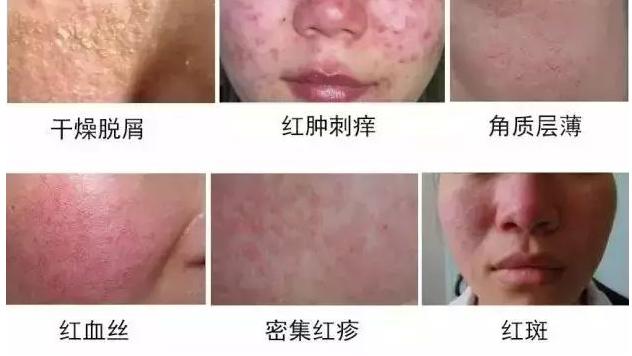 钻戒 秋冬季敏感肌肤的八种状态，错误的护肤方式，伤害了多少少女心