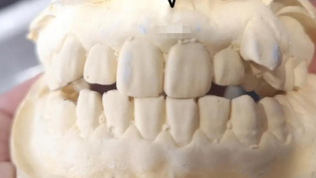 牙齿|成人虎牙怎么矫正？