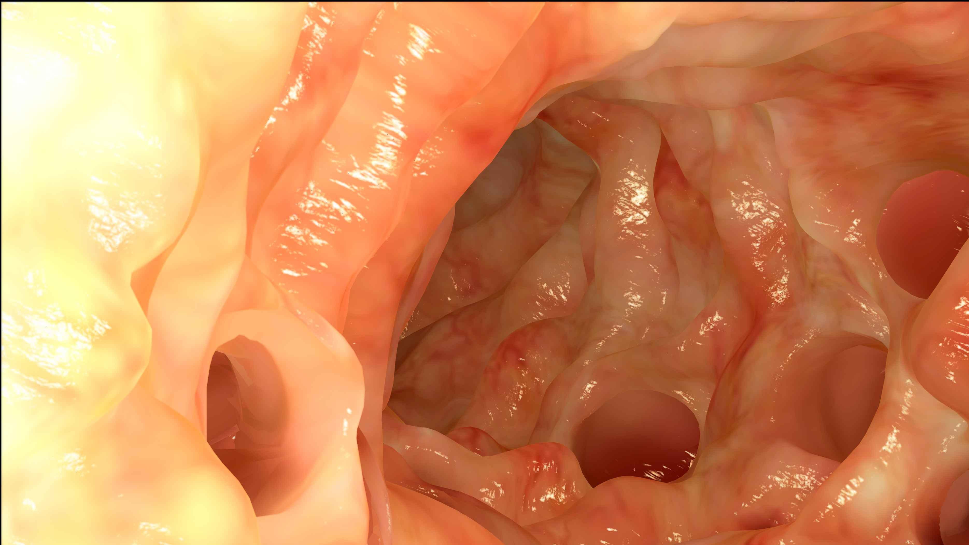 大肠癌|超过美国成为全球第一？这种被忽视的癌症，如今可能缠上你父母