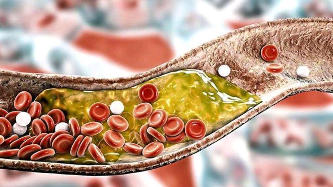 中药|胆固醇升高了，日常有什么方法可以控制？提醒：做好5点有帮助