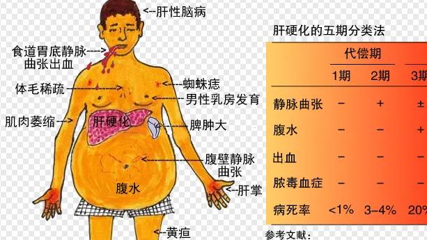 肝硬化|肝硬化常见的并发症有哪些？