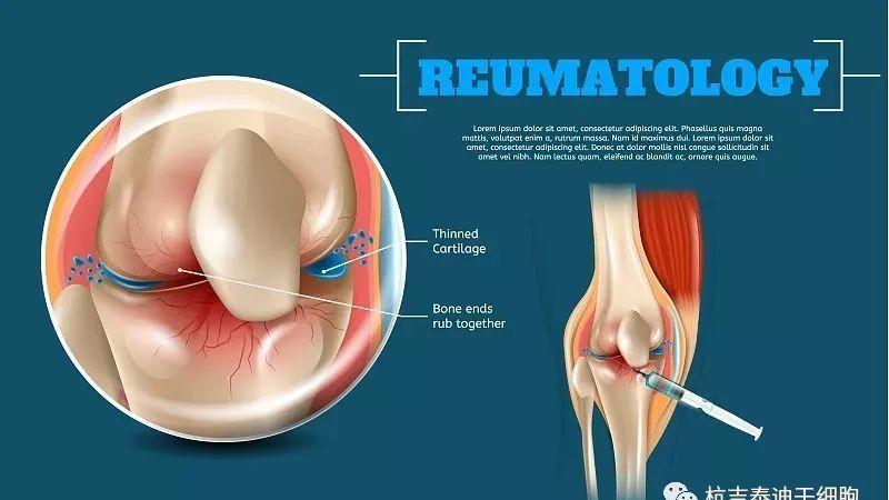 近年来干细胞疗法在治疗膝骨关节炎中的应用回顾