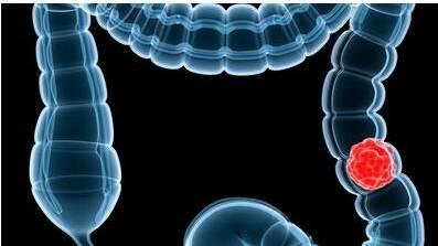 肾病|这仨习惯可能是肠道病变的“加速器”，做好这2点，肠道会感谢你