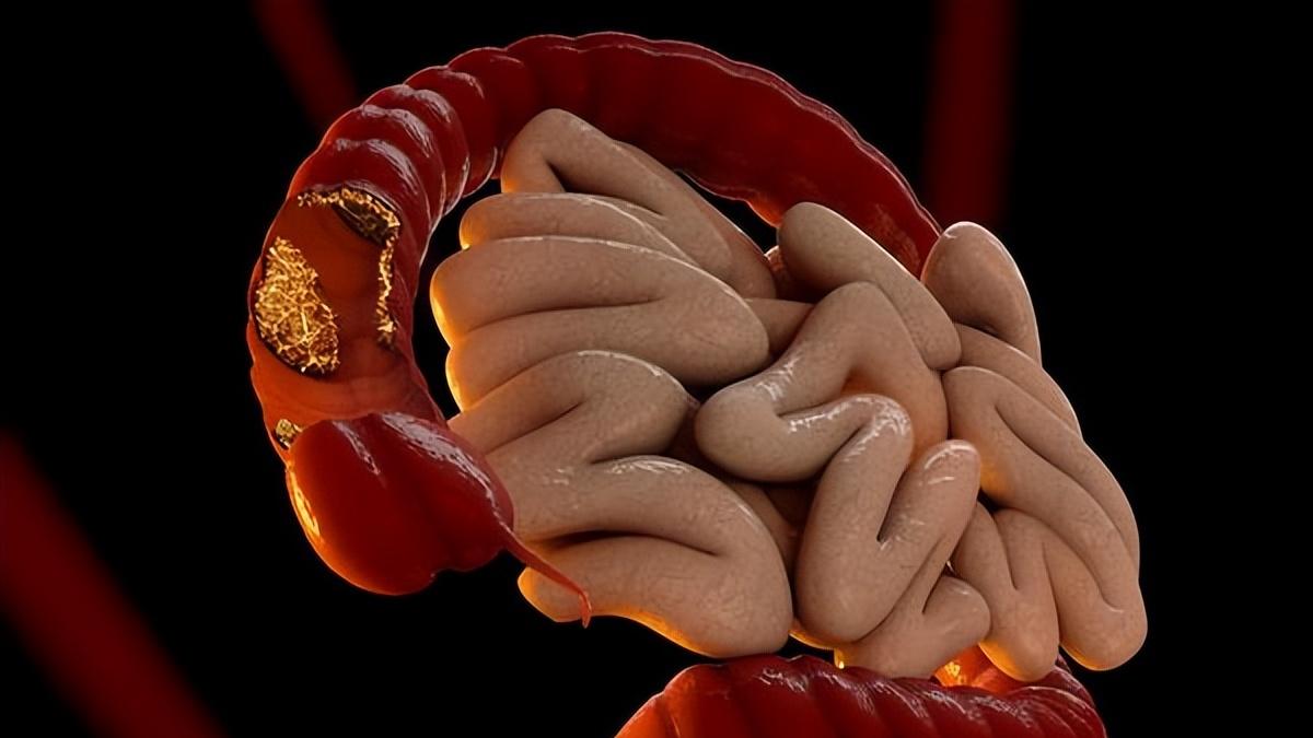 咽炎|9成患者被误判？一旦出现便血，咱们如何区分是肠癌，还是痔疮？