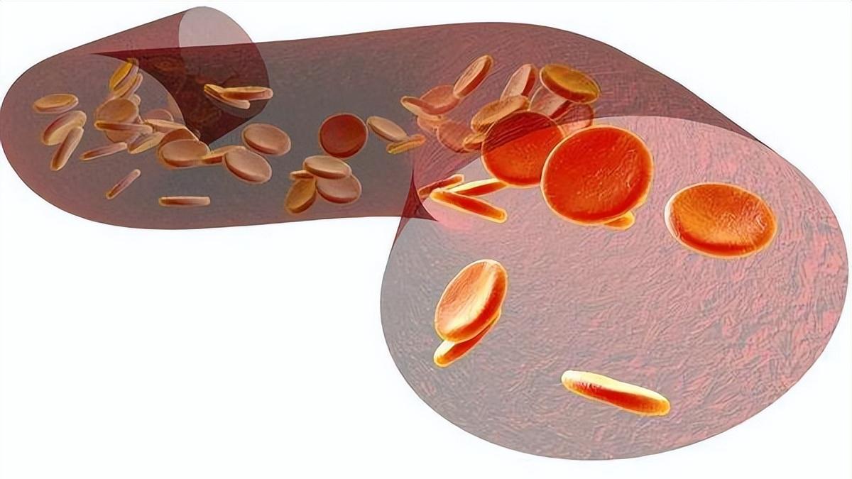 高血脂|血脂一高生百病，5个身体表现提示血脂异常，30秒自测一下