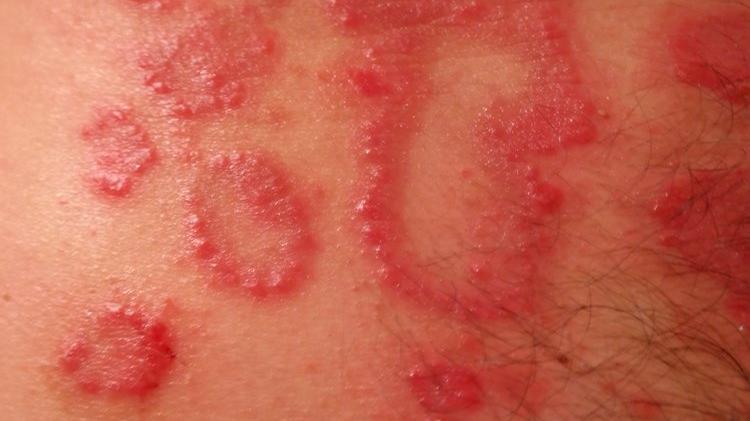 肿瘤|不是皮肤病，而是癌症信号？皮肤出现4种异样，警惕癌症来袭