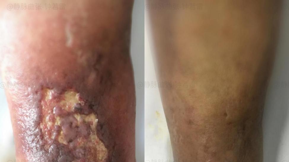 |患者问答|老烂腿是绝症吗