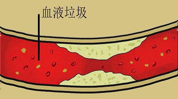 耳鸣|血管被“拴住”了，别紧张，做好这3件事，可能血管想不通都难