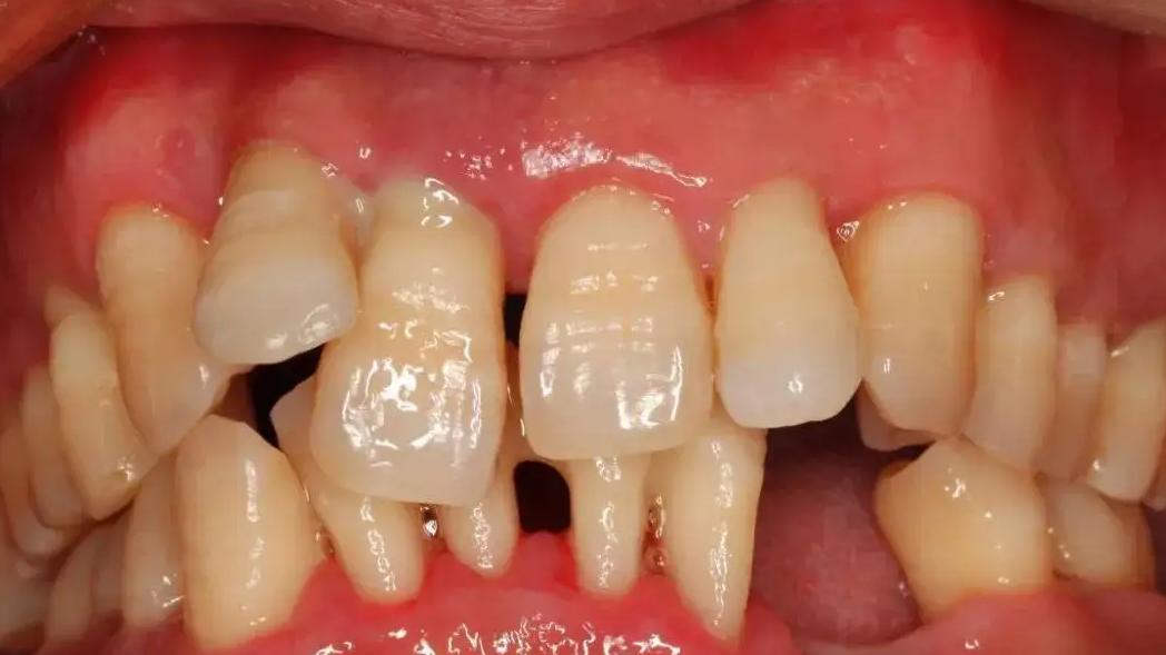 肝癌|仔细观察，老人家的牙齿，大都逃不过这3个问题