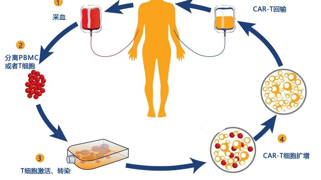 多发性骨髓瘤|CAR-T细胞疗法CT053治疗复发/难治多发性骨髓瘤的临床疗效