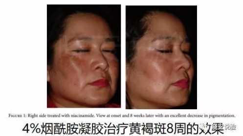 烟酰胺 烟酰胺真能美白吗？SK2、Olay、烟酰胺原液哪个好用？