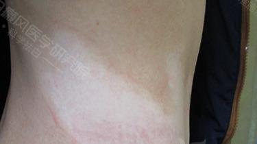 白癜风|白癜风患者为什么坚持治疗？