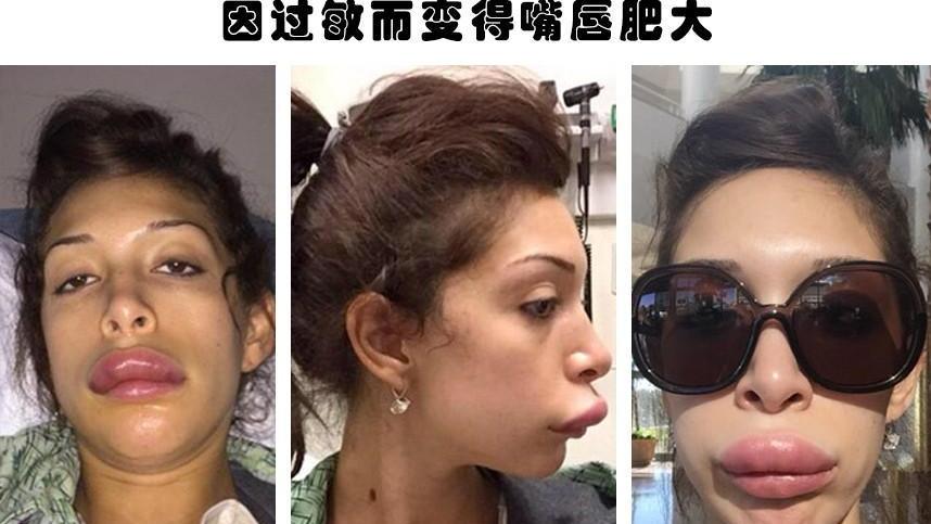 整容|整容失败的代价：据说因为整容而毁掉了自己容貌的6个人