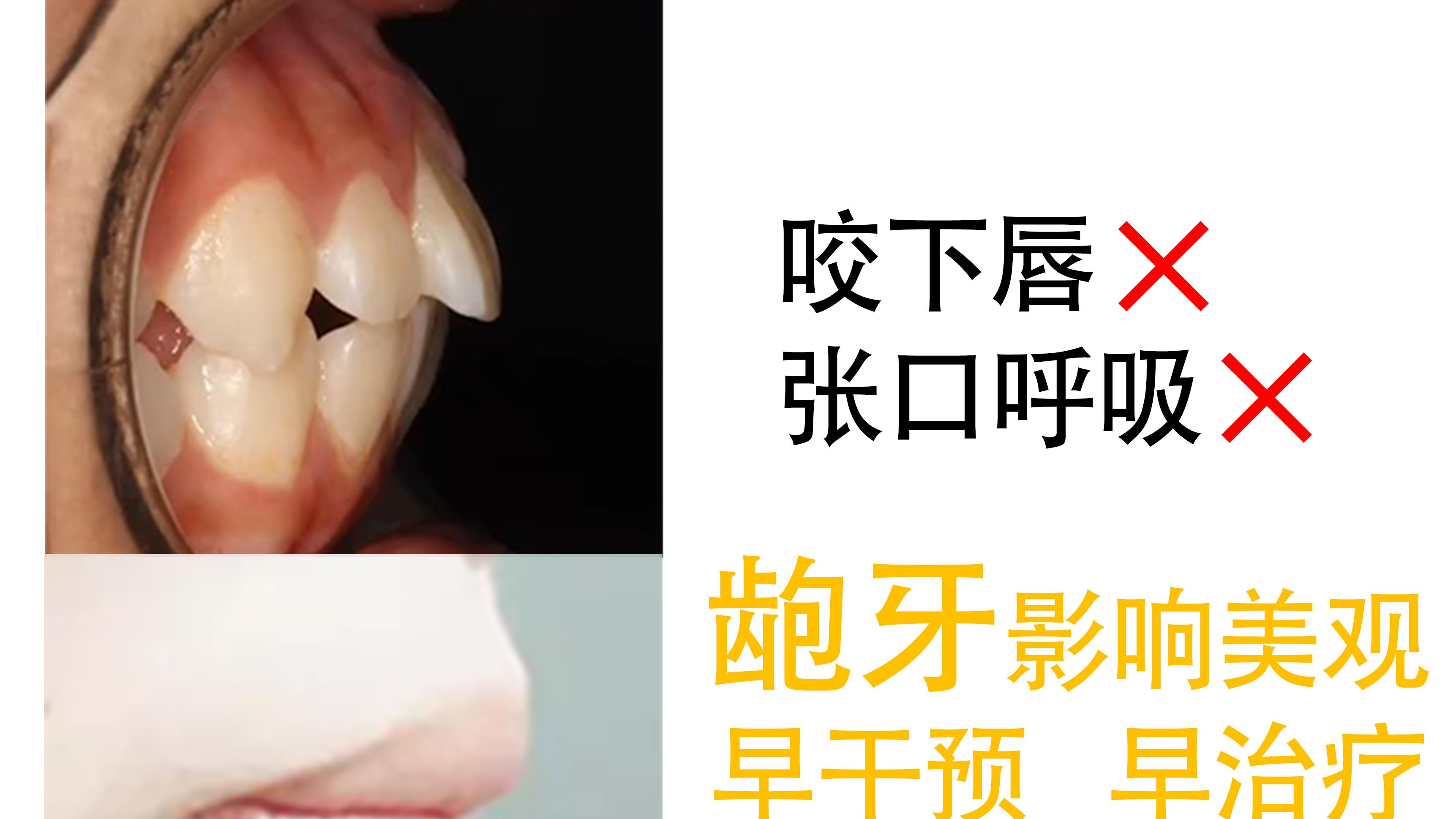 牙齿|「儿童龅牙」快改掉这些习惯，不然孩子龅牙！