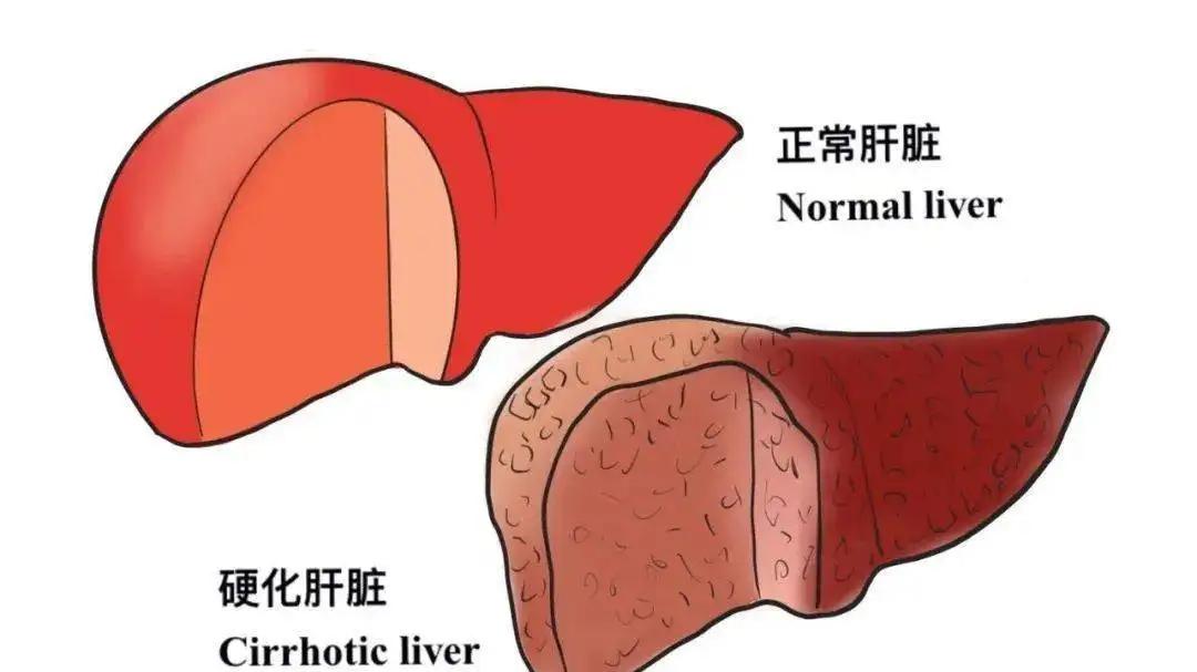 肝硬化|想要扭转早期肝硬化，你需要做好这2点