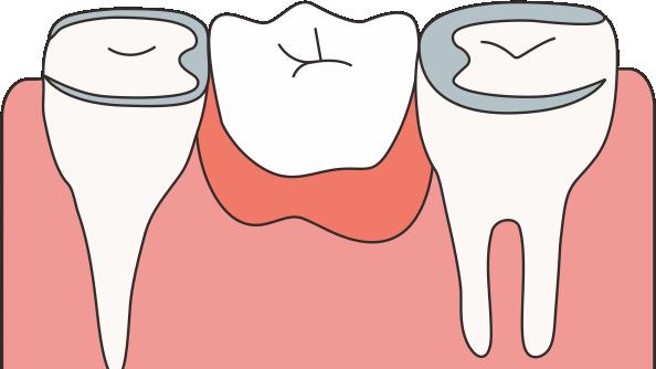 肿瘤|三种缺牙修复方式对比，看完摆脱选择困难症