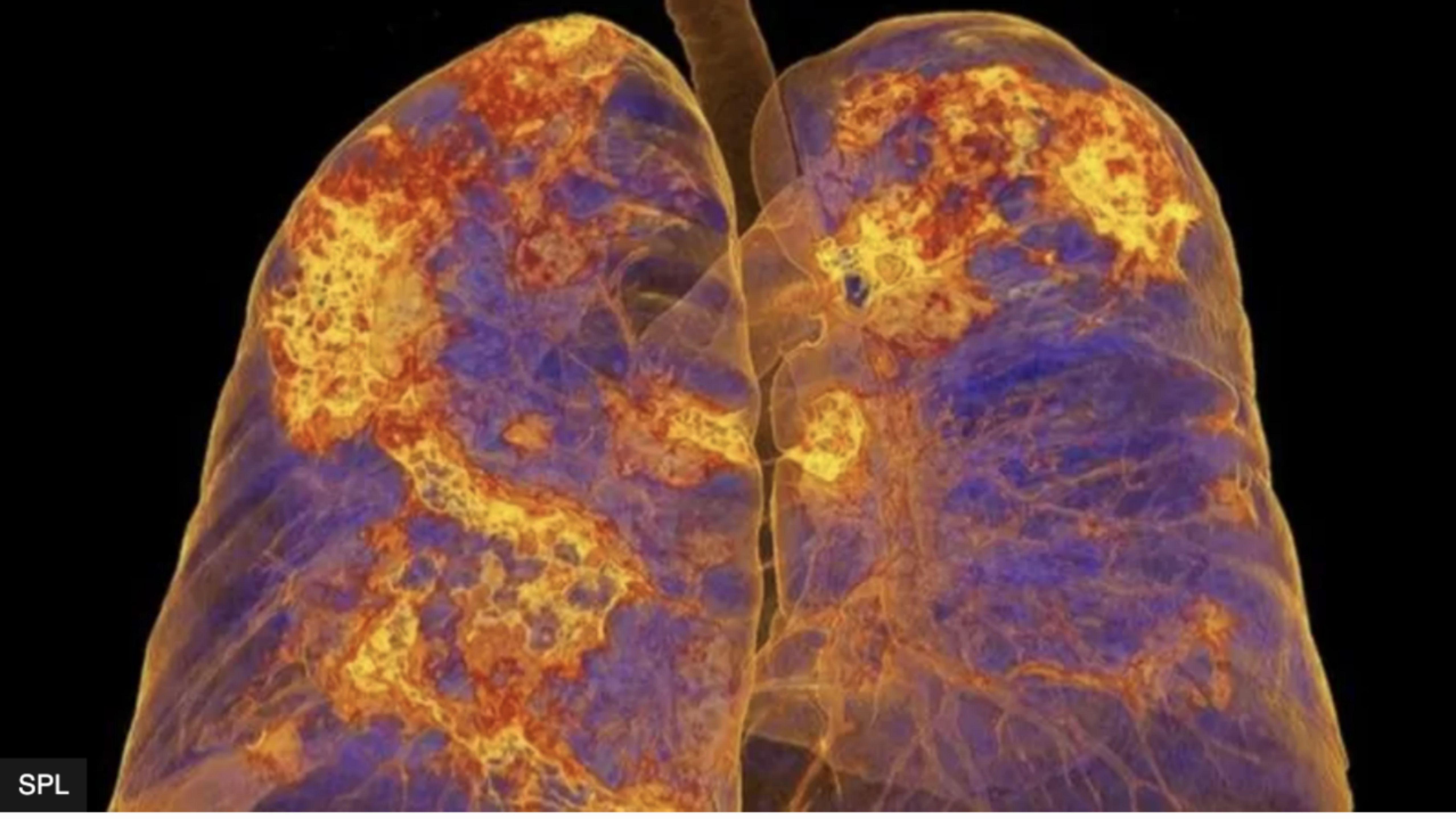 医生|新冠疫情：“长新冠”患者的经历和感受