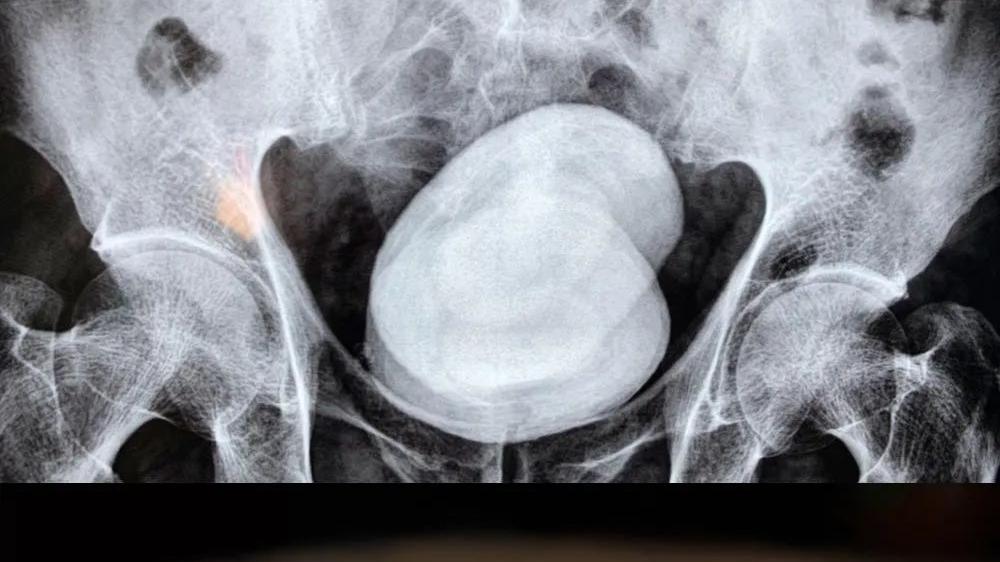 蔬菜|膀胱，一个“忍气吞声”的器官，这几个日常行为最容易让它受伤