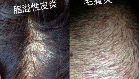 衰老|脂溢性脱发要尽早治疗，否则会引发这些病症！