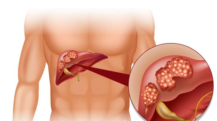 肝癌|肝癌并非毫无征兆，上厕所时出现3个异常，可能是肝脏在“求救”